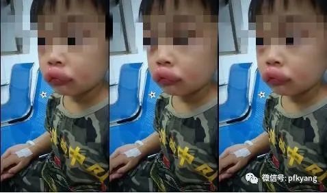 男孩吃葡萄過敏腫成嘟嘟嘴怎么回事？畫面詳情曝光網(wǎng)友忍不住笑了