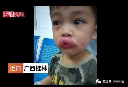 男孩吃葡萄過敏腫成嘟嘟嘴怎么回事？畫面詳情曝光網(wǎng)友忍不住笑了(圖5)
